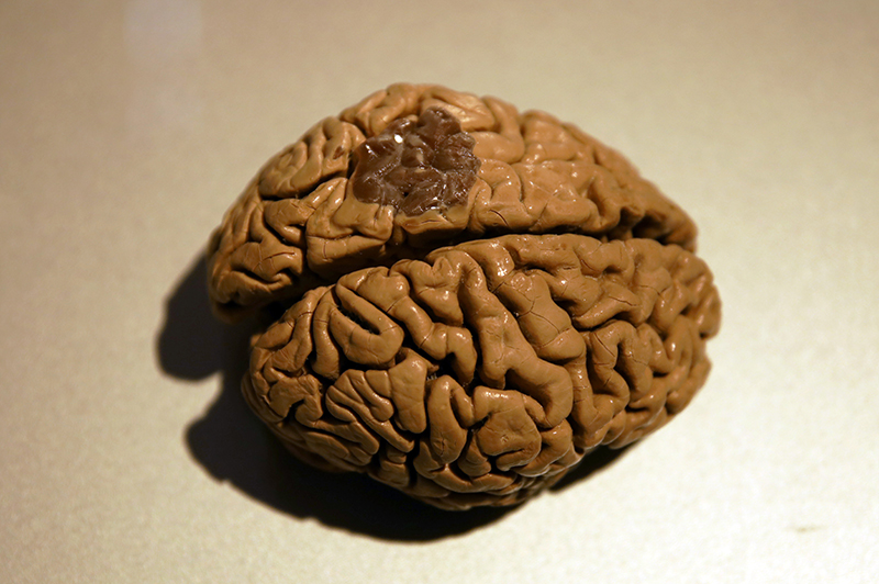 Menschliches Gehirn welches mit Alzheimer erkrankt ist

